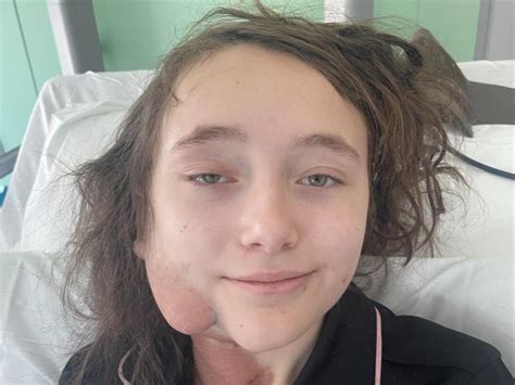 girlfriend facials|Girl with facial tumours forced to wait for vital operation due to .